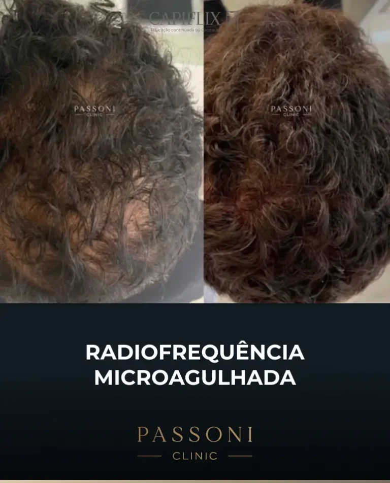 Passoni = antes e depois 1