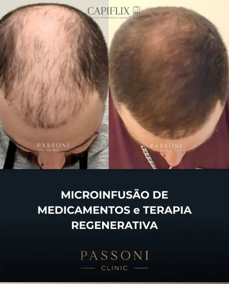 Passoni = antes e depois 10