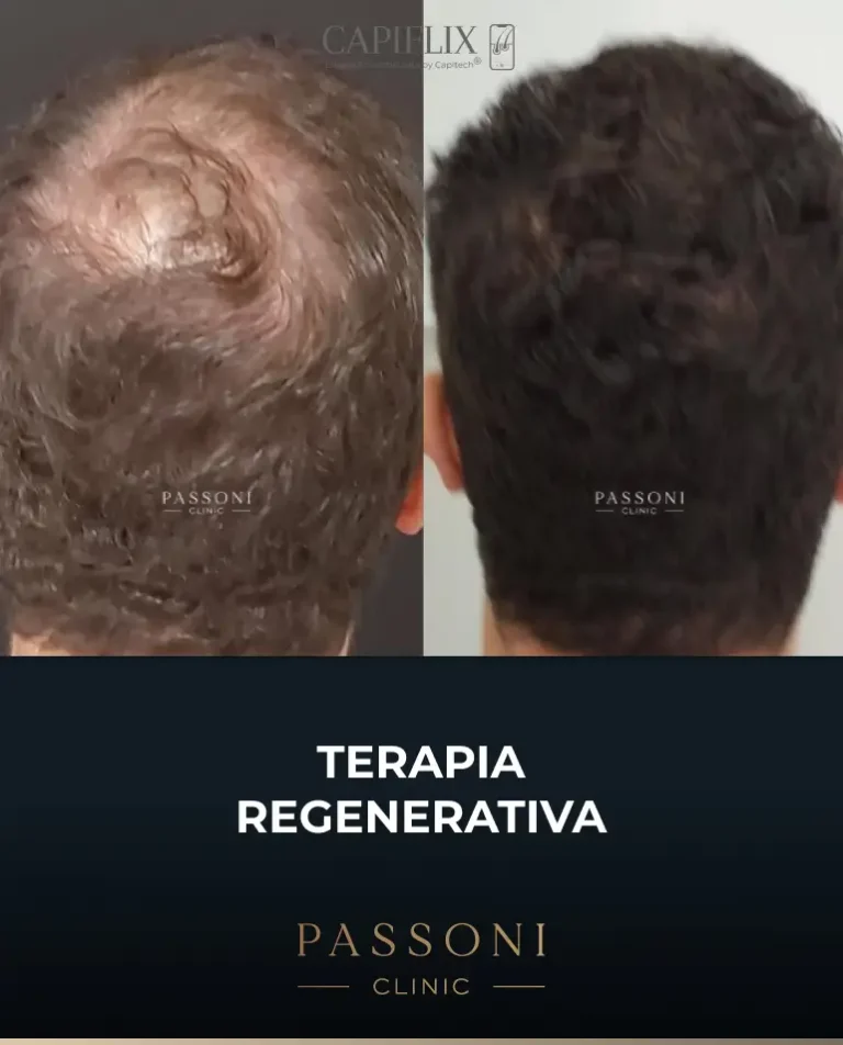 Passoni = antes e depois 13