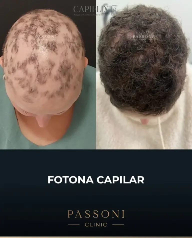 Passoni = antes e depois 14