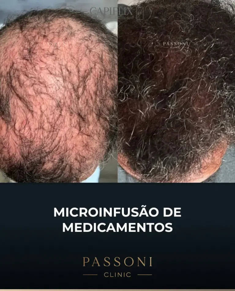 Passoni = antes e depois 15