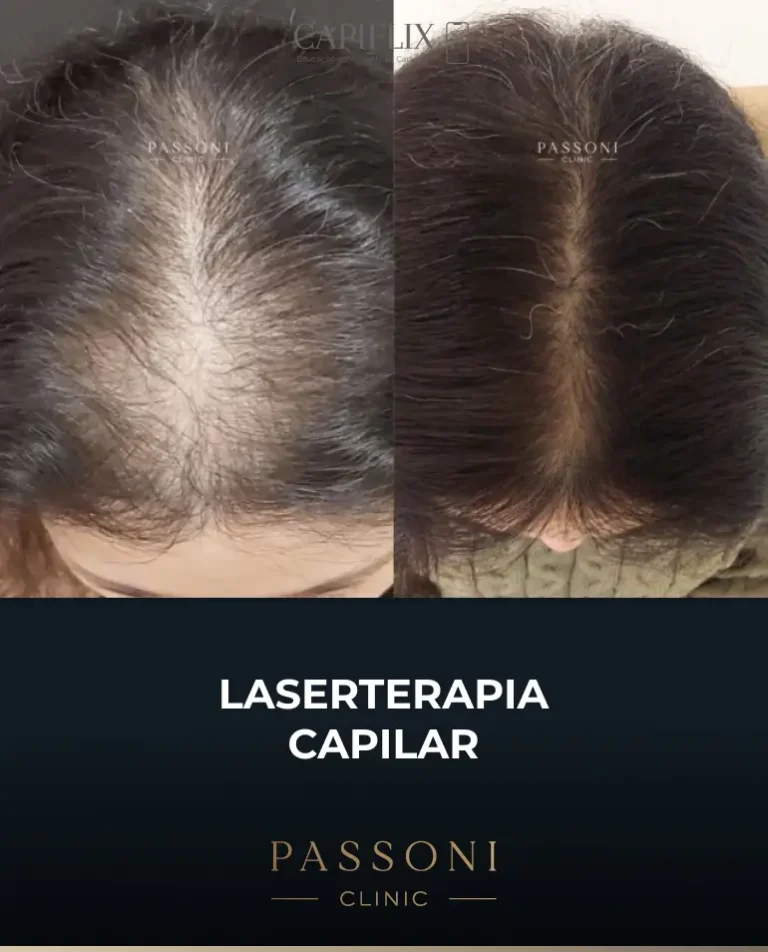 Passoni = antes e depois 16