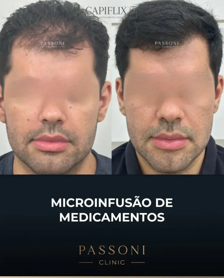 Passoni = antes e depois 17