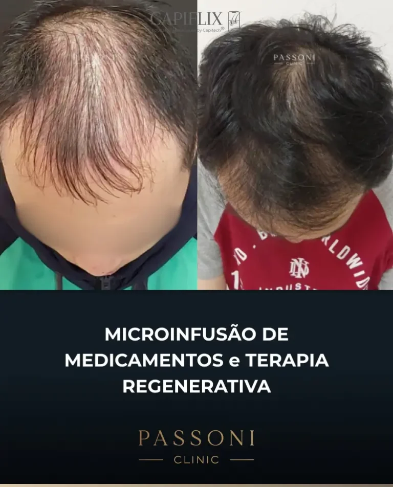 Passoni = antes e depois 18