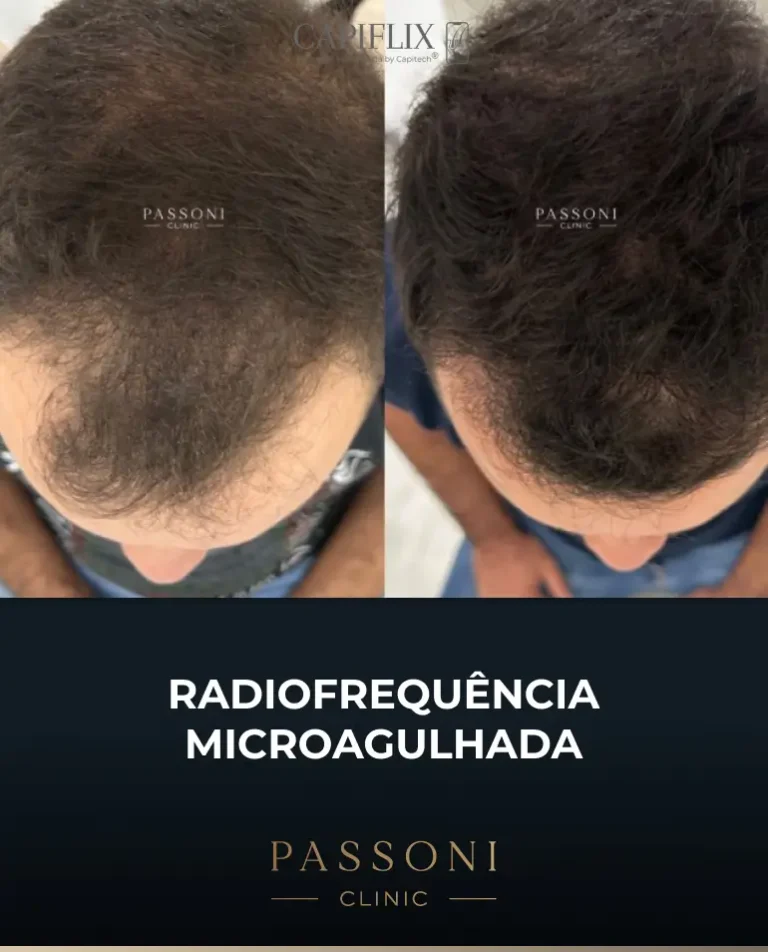 Passoni = antes e depois 19