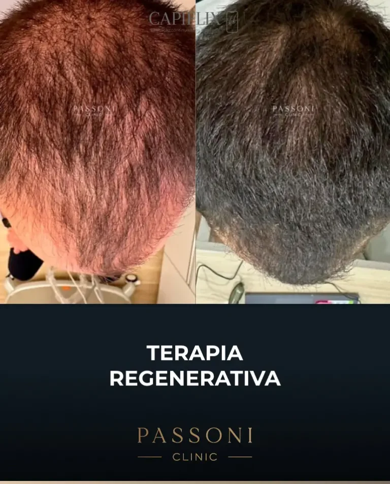 Passoni = antes e depois 20