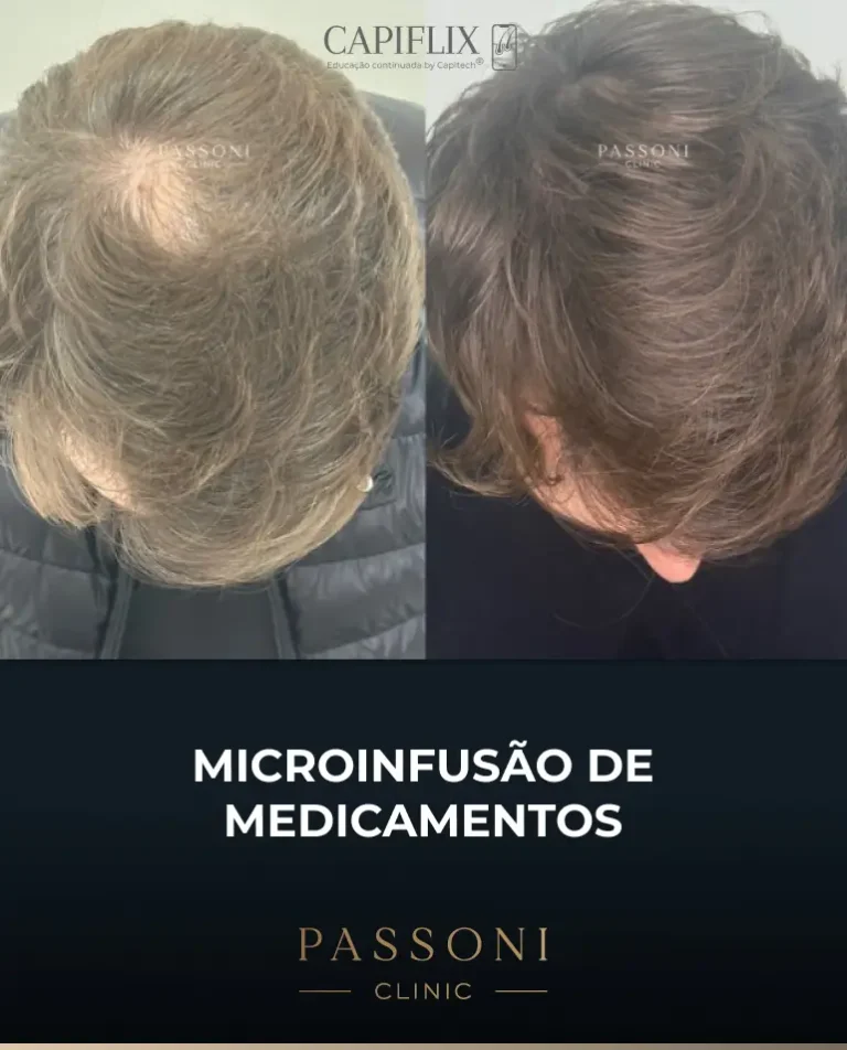 Passoni = antes e depois 21