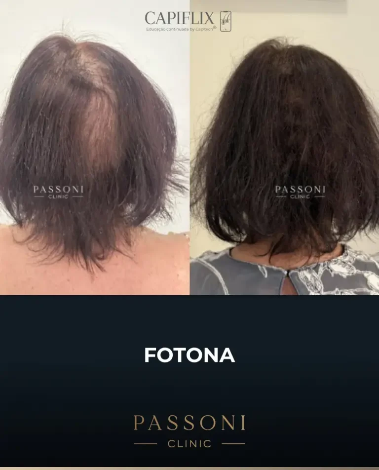 Passoni = antes e depois 3