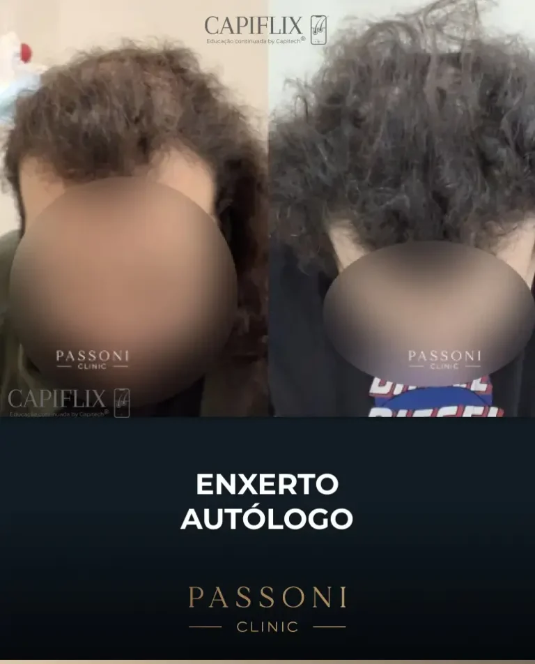 Passoni = antes e depois 4
