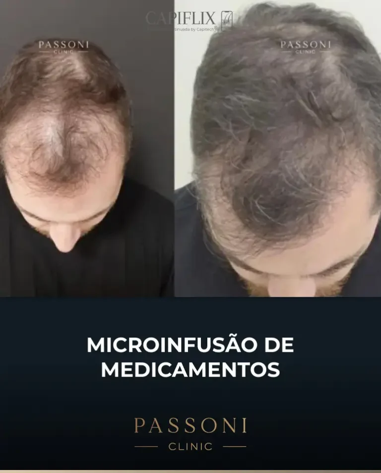 Passoni = antes e depois 5