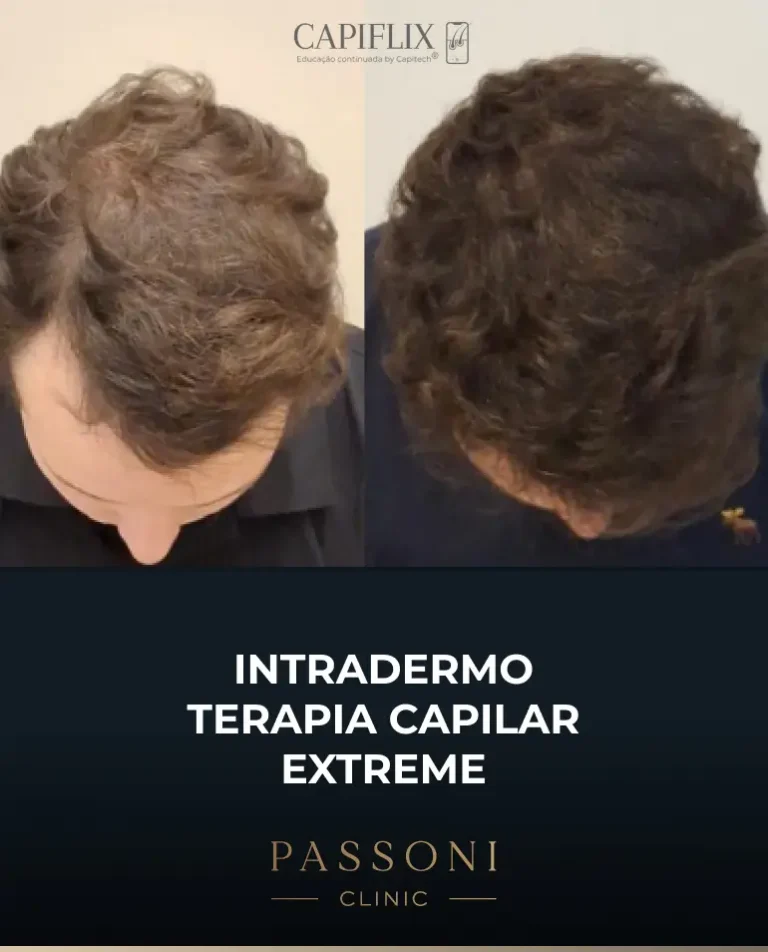 Passoni = antes e depois 6