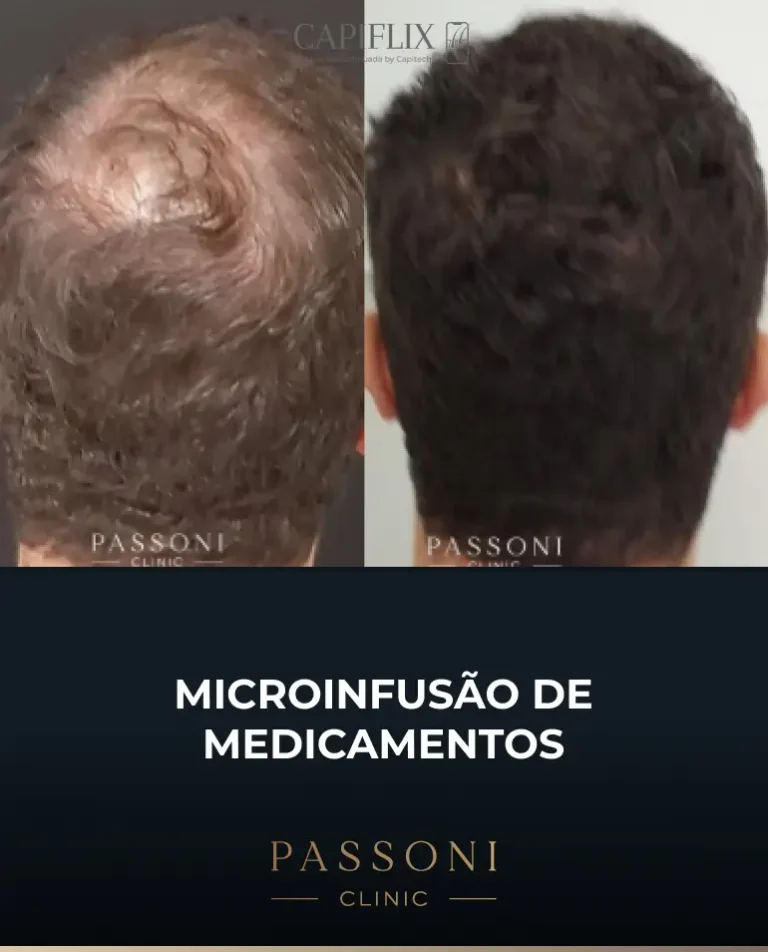 Passoni = antes e depois 7