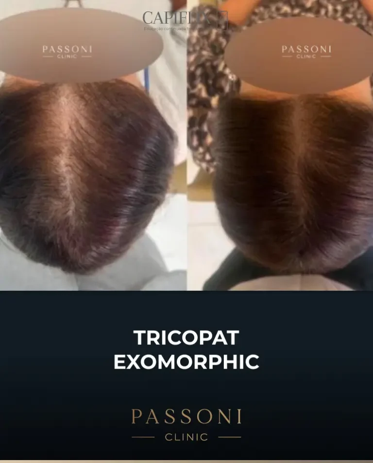 Passoni = antes e depois 8