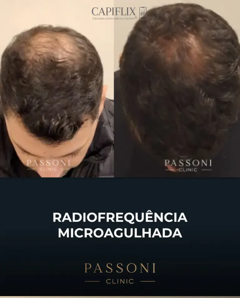 Passoni = antes e depois 9